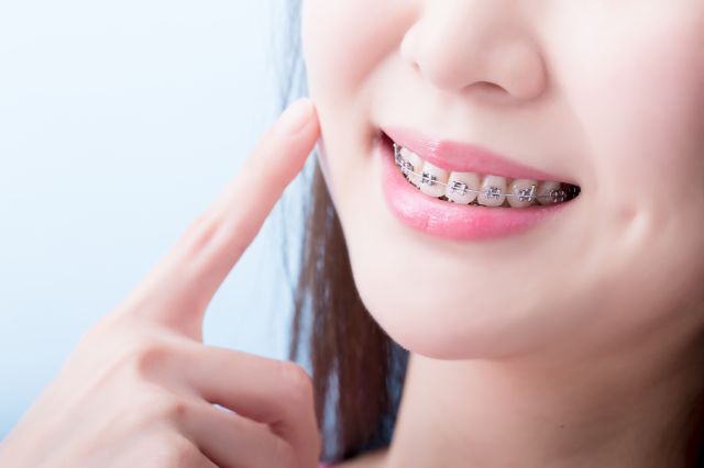 歯の矯正を見せる女性