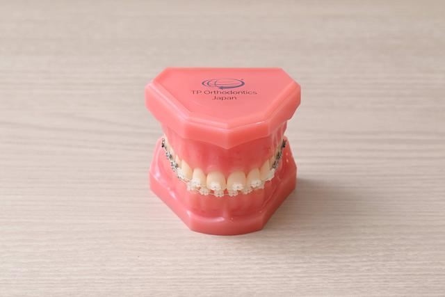 表側ワイヤー矯正