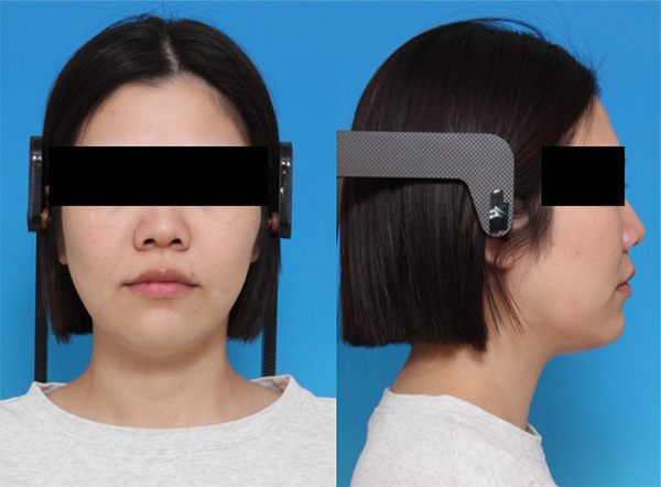 上下顎前突（口元の突出・口ゴボ）治療終了時