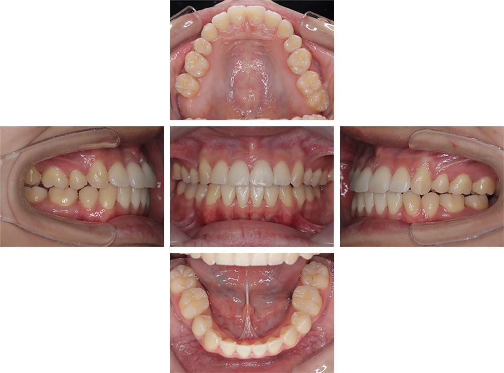 上下顎前突(口元の突出・口ゴボ)治療終了時