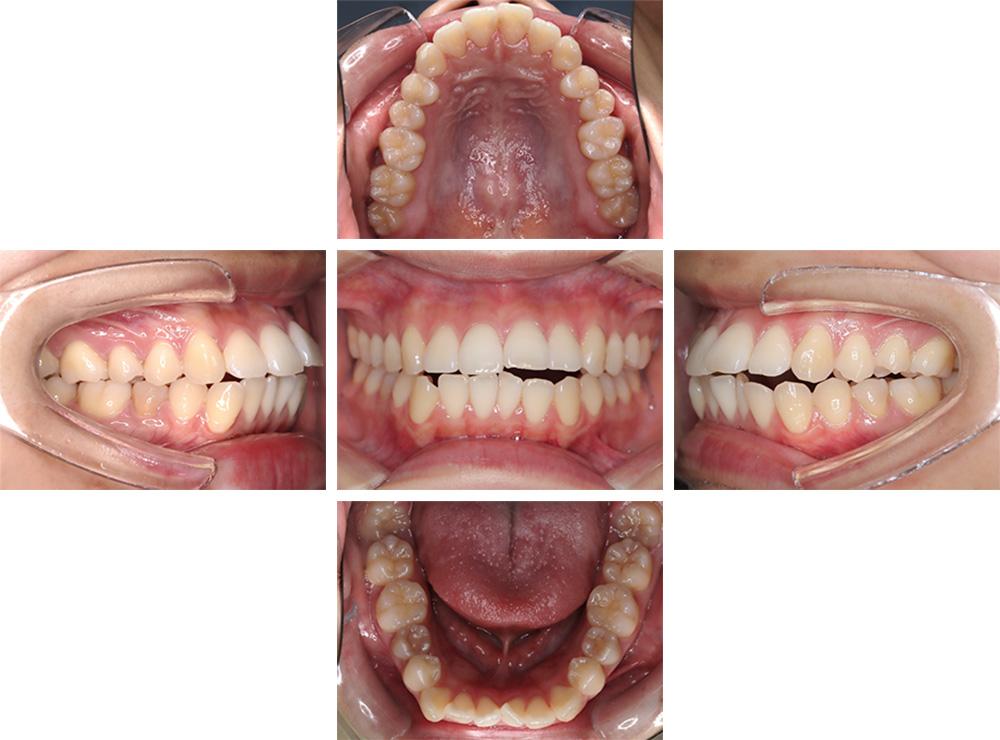 上下顎前突(口元の突出・口ゴボ)治療開始時